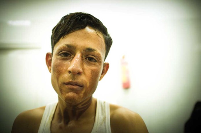 A young man attends Al Ahli Hospital's burns clinic – Gaza City June 2016